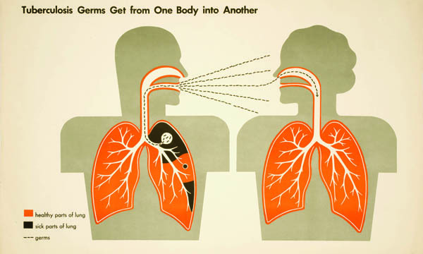 tuberculosis