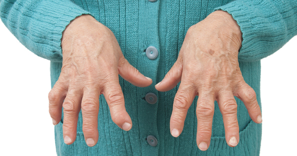 rheumatoid-arthritis-hands-2