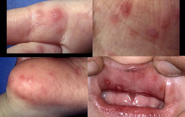 Baby-With-FEver-And-Rash-due-to-HAnd-Mouth-And-Foot-Disease