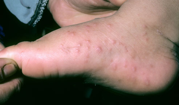 phototake_hand-foot-mouth_disease_foot_rash