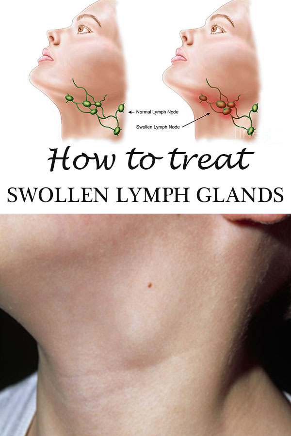 supraclavicular lymph nodes swollen left side causes