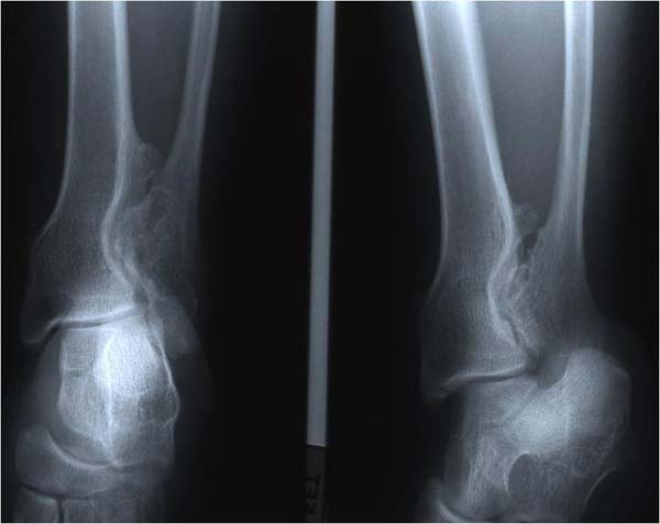 osteochondroma44 copy