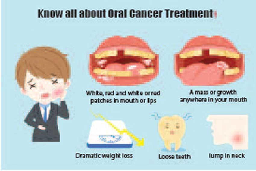 Oral cancer: the unseen killer | Daily Mirror - Sri Lanka Latest ...