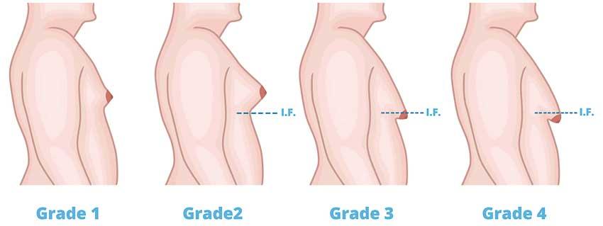 End Gynaecomastia with a simple surgery Daily Mirror Sri Lanka