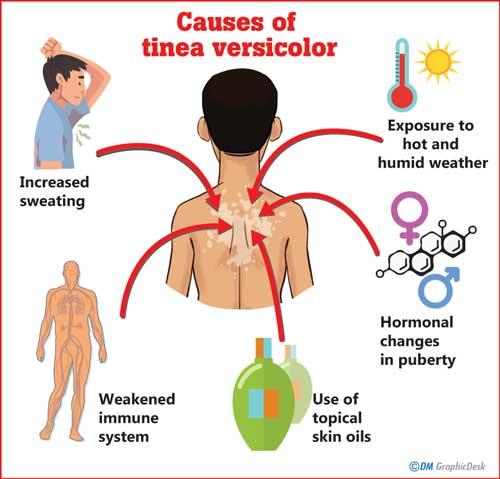 Tinea Versicolor, Diagnosis And Treatment