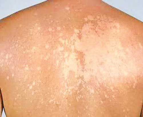 Tinea Versicolor: Causes, Symptoms, Risk Factors, Diagnosis, Treatment and  Prevention