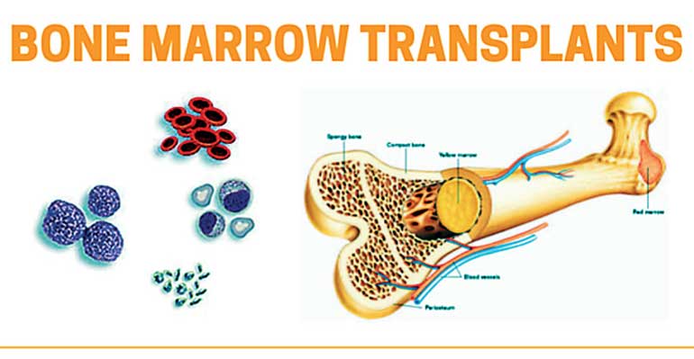 Nawaloka Hospital completes 30 successful bone marrow transplants | Daily FT