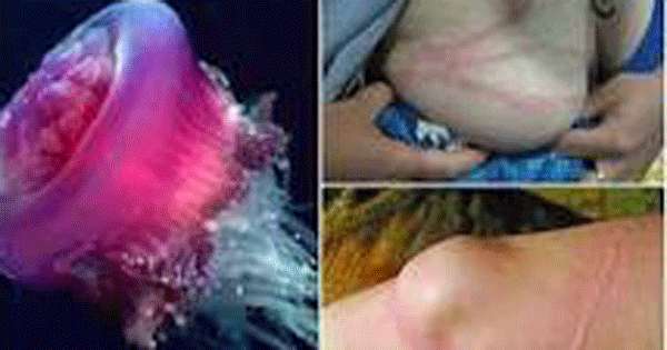 ජෙලිෆිෂ් නිසා මුහුදේ දිය නෑ 10ක් රෝහලේ