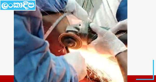 උදරය පසාරු කළ යකඩ කූර සාර්ථකව එළියට