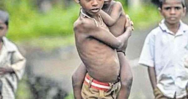 පාසල් දරැවන්ගෙන් පහෙන් එකකට මන්දපෝෂණය