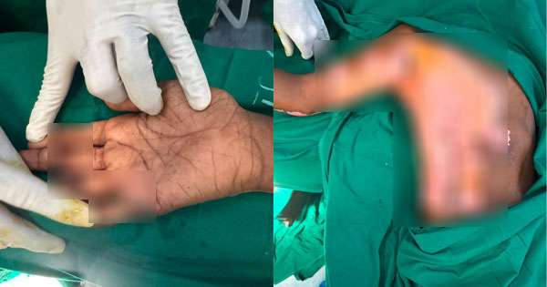 සරුංගල් අනතුරු වැඩි වෙලා
