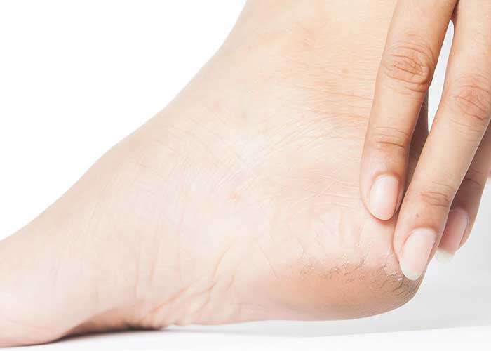 පැළෙන යටිපතුල් වලට විසඳුමක්