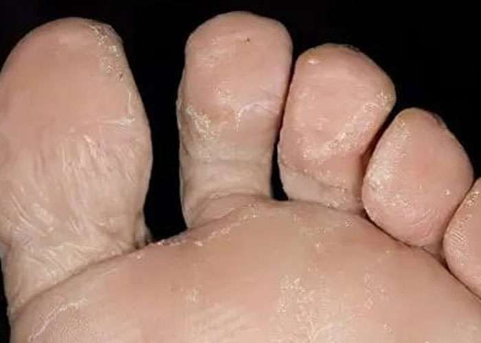 වැසි සමයත් සමඟ ඔබේ පාද රැකගන්න