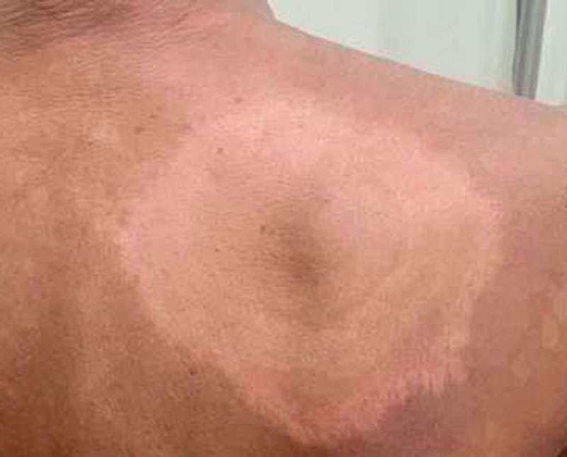 මොරටුවට ලාදුරු බියක්