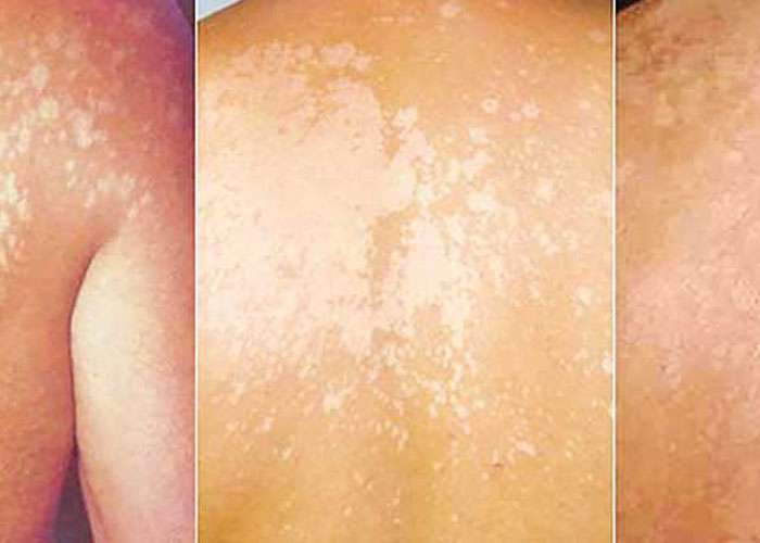 අළුහම් වලට තිත