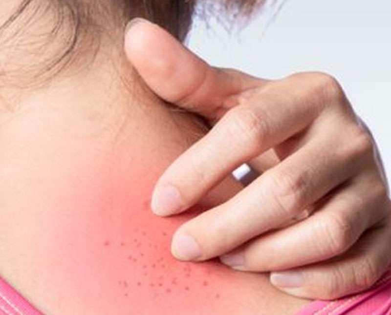 කුෂ්ඨ රෝග හදා ගන්නේ නැතුව ඉමුද?