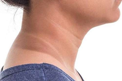 බෙල්ල කළු වන්නේ වෙනත් ගැටලුවක ලකුණක්ද?