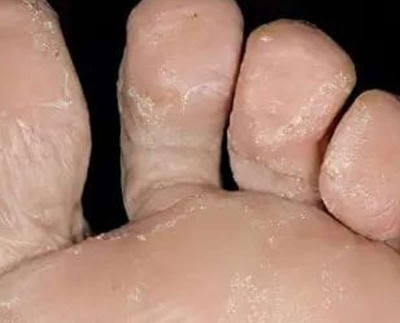 වැසි සමයත් සමඟ ඔබේ පාද රැකගන්න